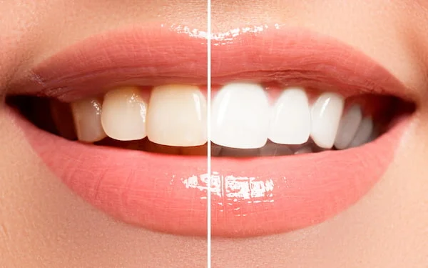 imagen de sonrisa donde muestra dientes brillantes