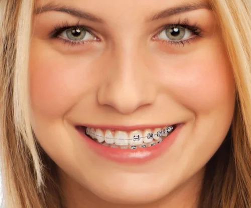 Imagen de una sonrisa brillante con brackets